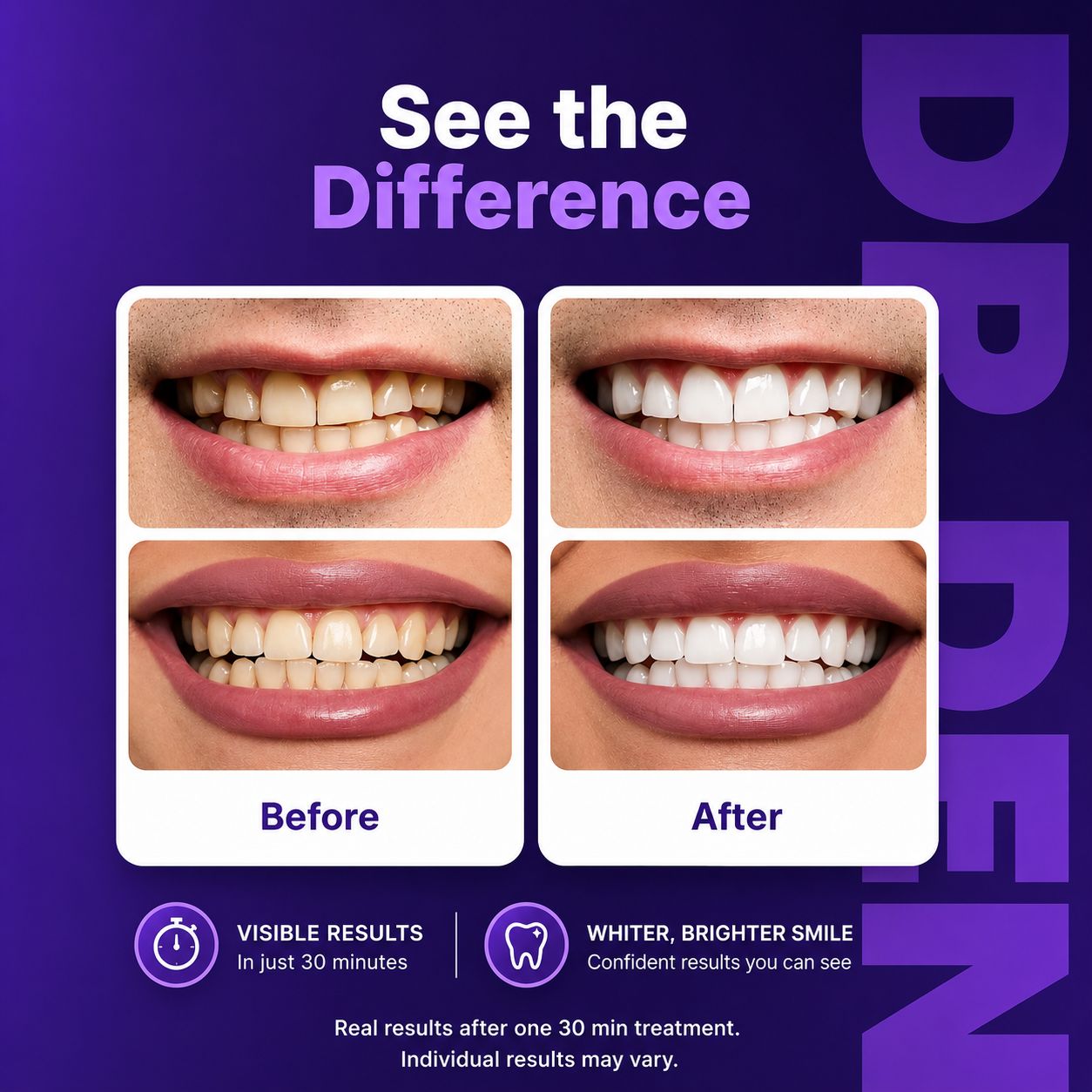 Dr.Dent® Enamel-Safe Purple Teeth Whitening Strips